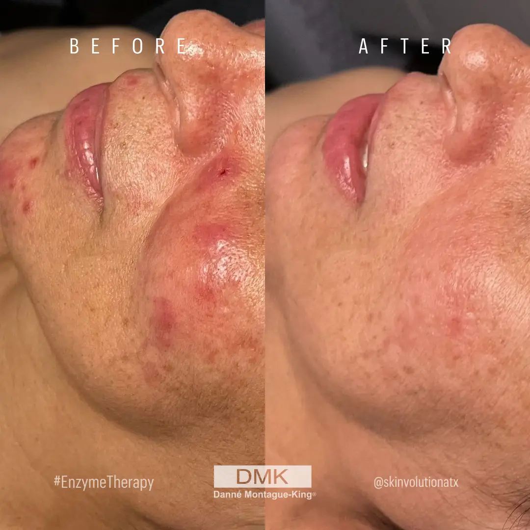 @skinvolutionatx Enzyme Therapy x2 Acne Rosacea B&A