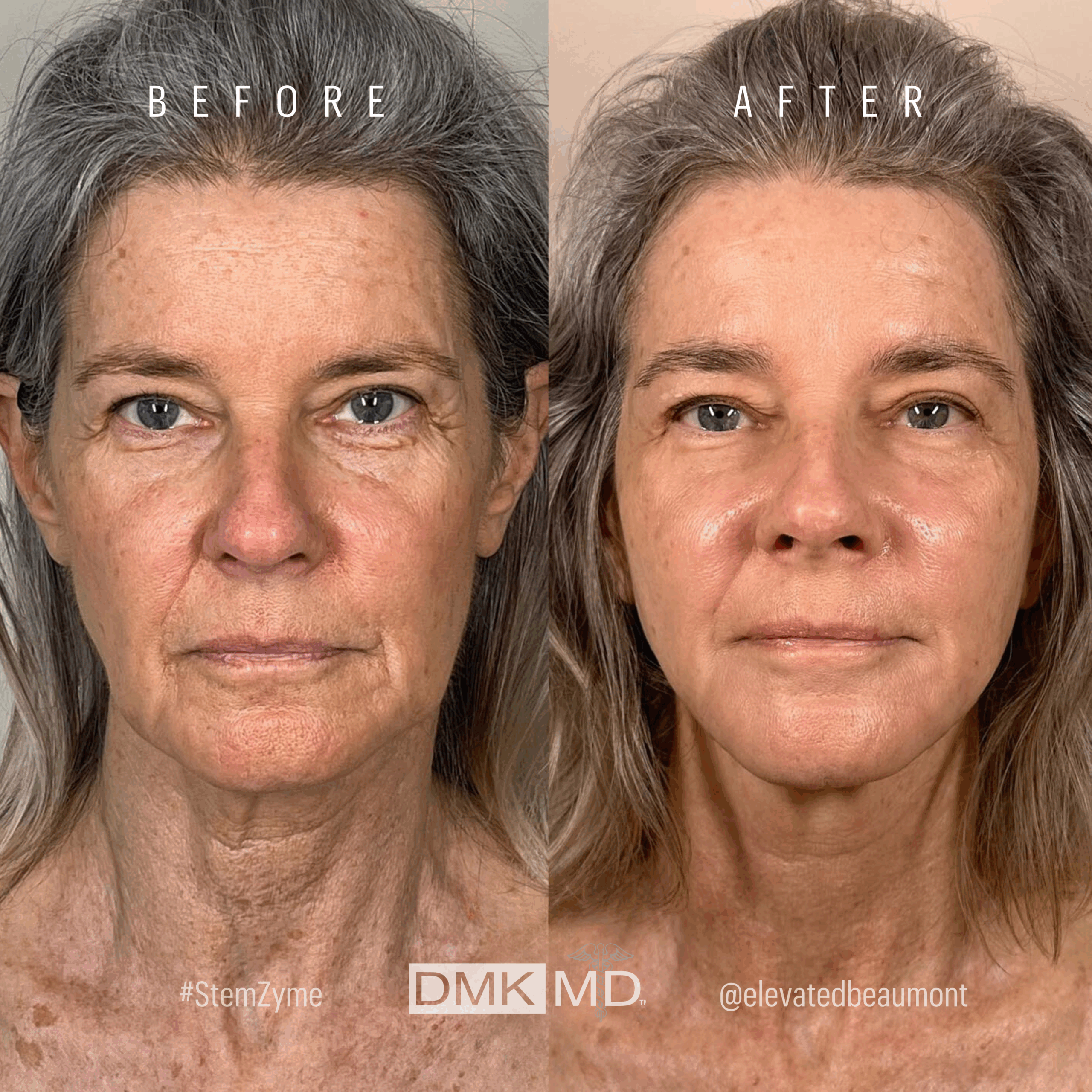 Aging