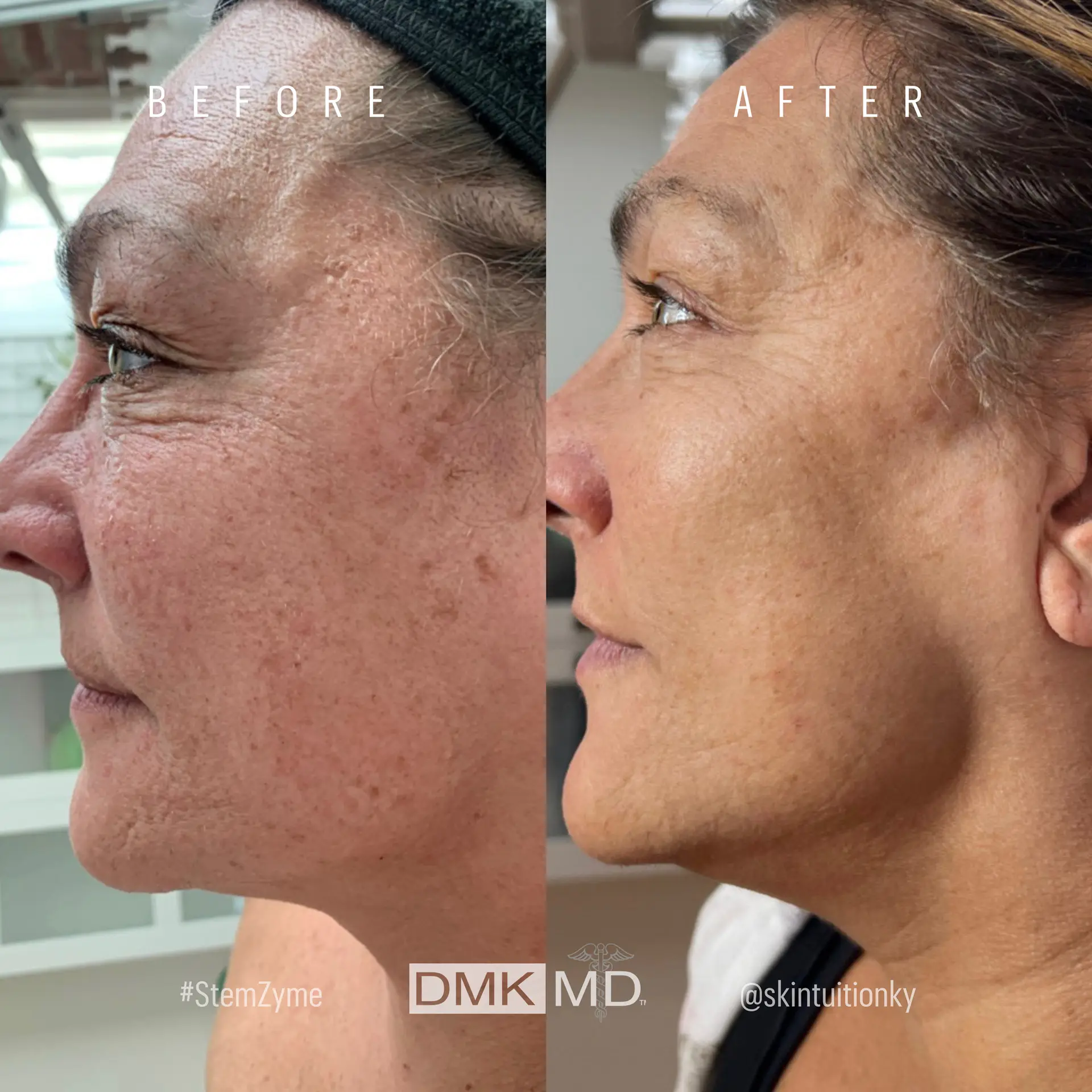 ProAlphaPeel
