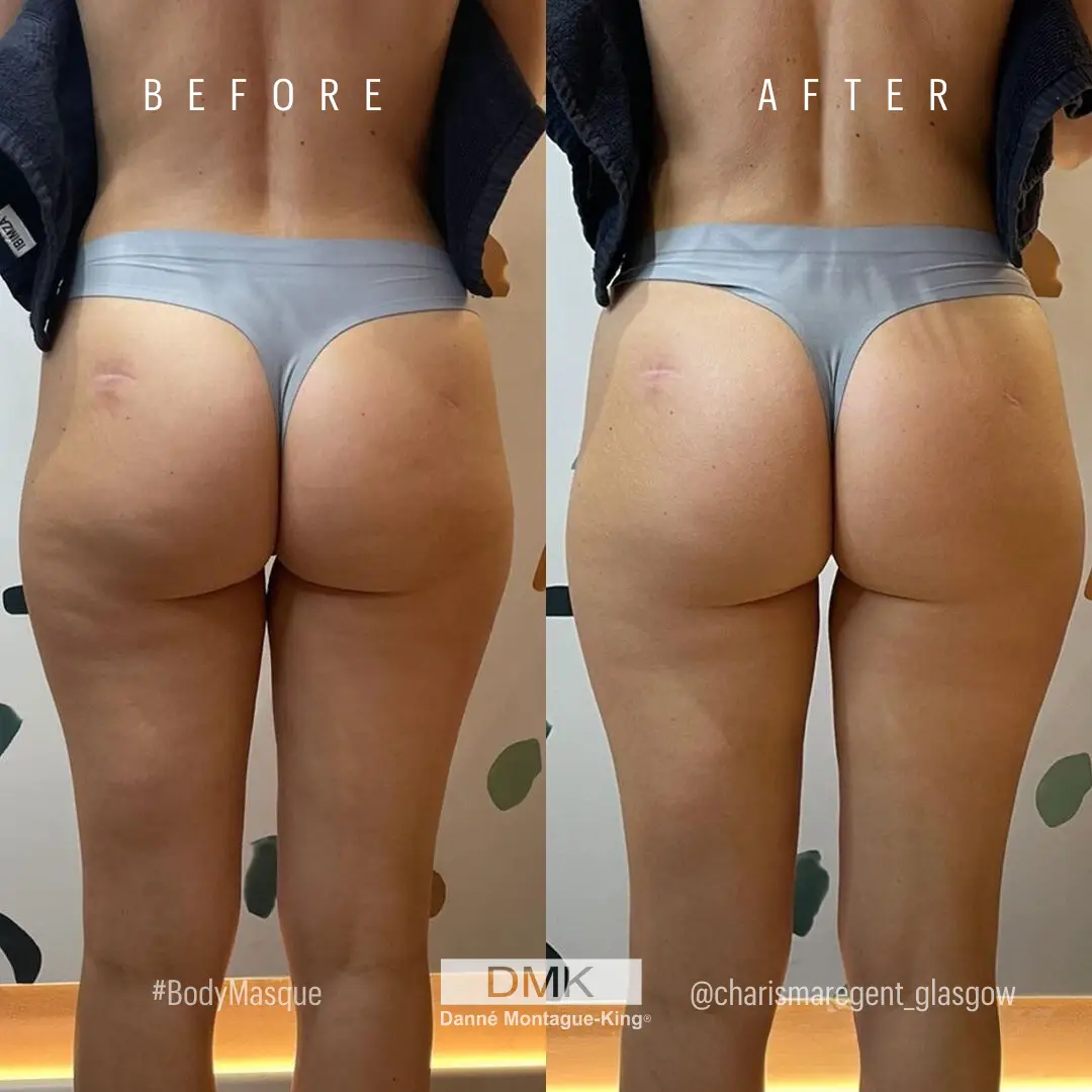 Cellulite