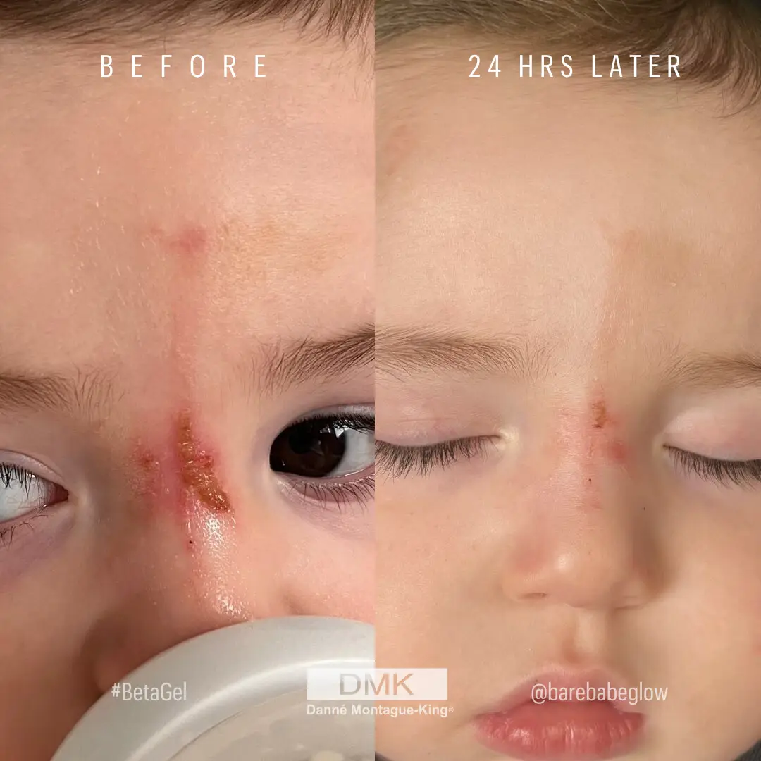 @barebabeglow-Beta-Gel-24-hr-difference-toddler-with-skin-damage-BA (1)