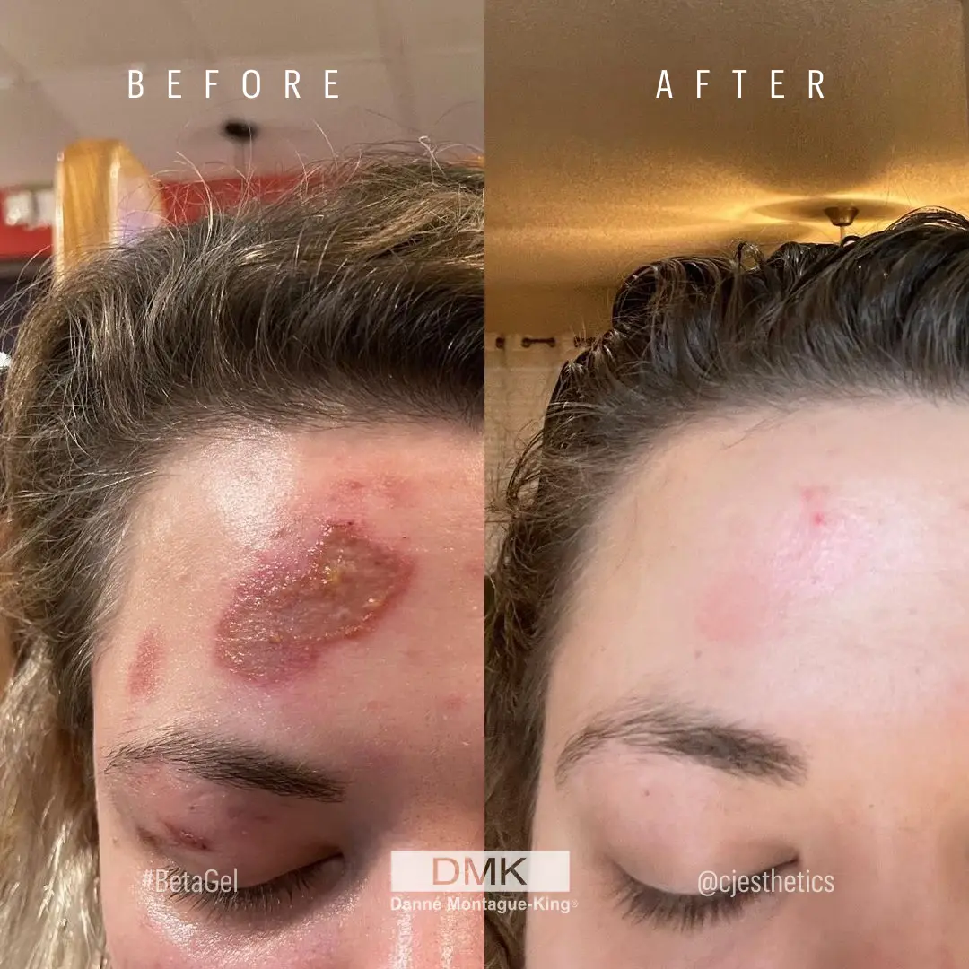 @cjesthetics-13-Days-Beta-Gel-Actrol-Powder-Skin-DamageBurn-BA-2 (1)