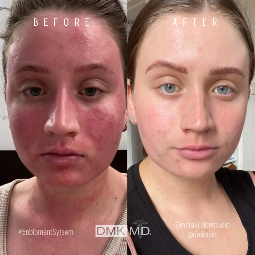 @dmkskin-DMKDifference-Home-Prescriptives-for-Perioral-Dermatitis-BA- (1)