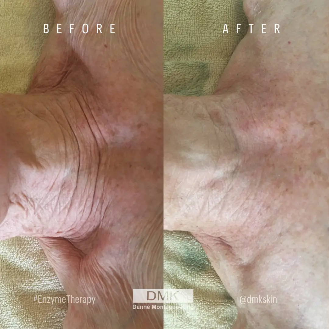 @dmkskin-Enzyme-Therapy-Age-Management-Results-Chest
