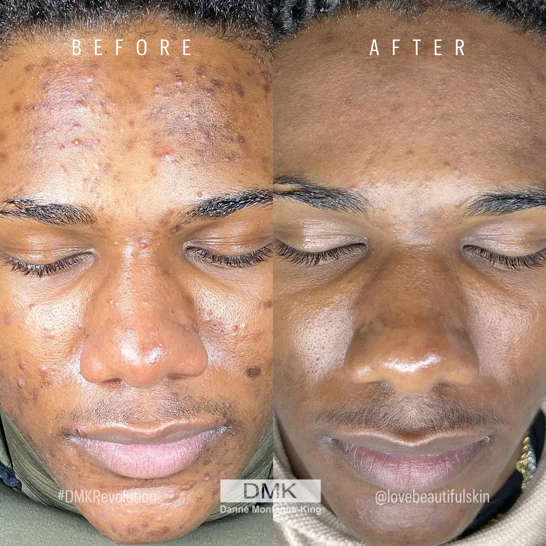 Pigmentation
