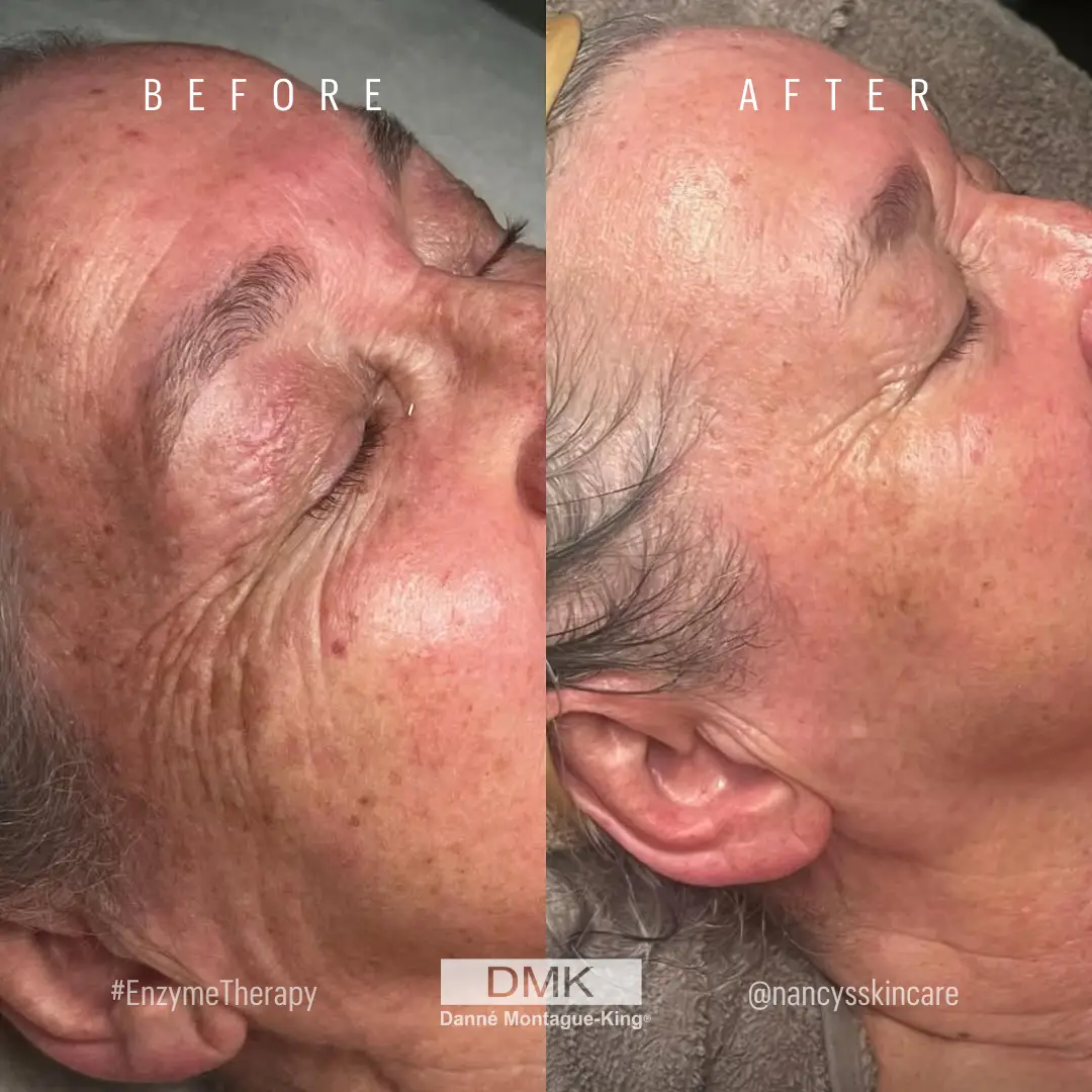 @nancysskincare-2x-Enzyme-Treatments-Age-Management-Pigmentation