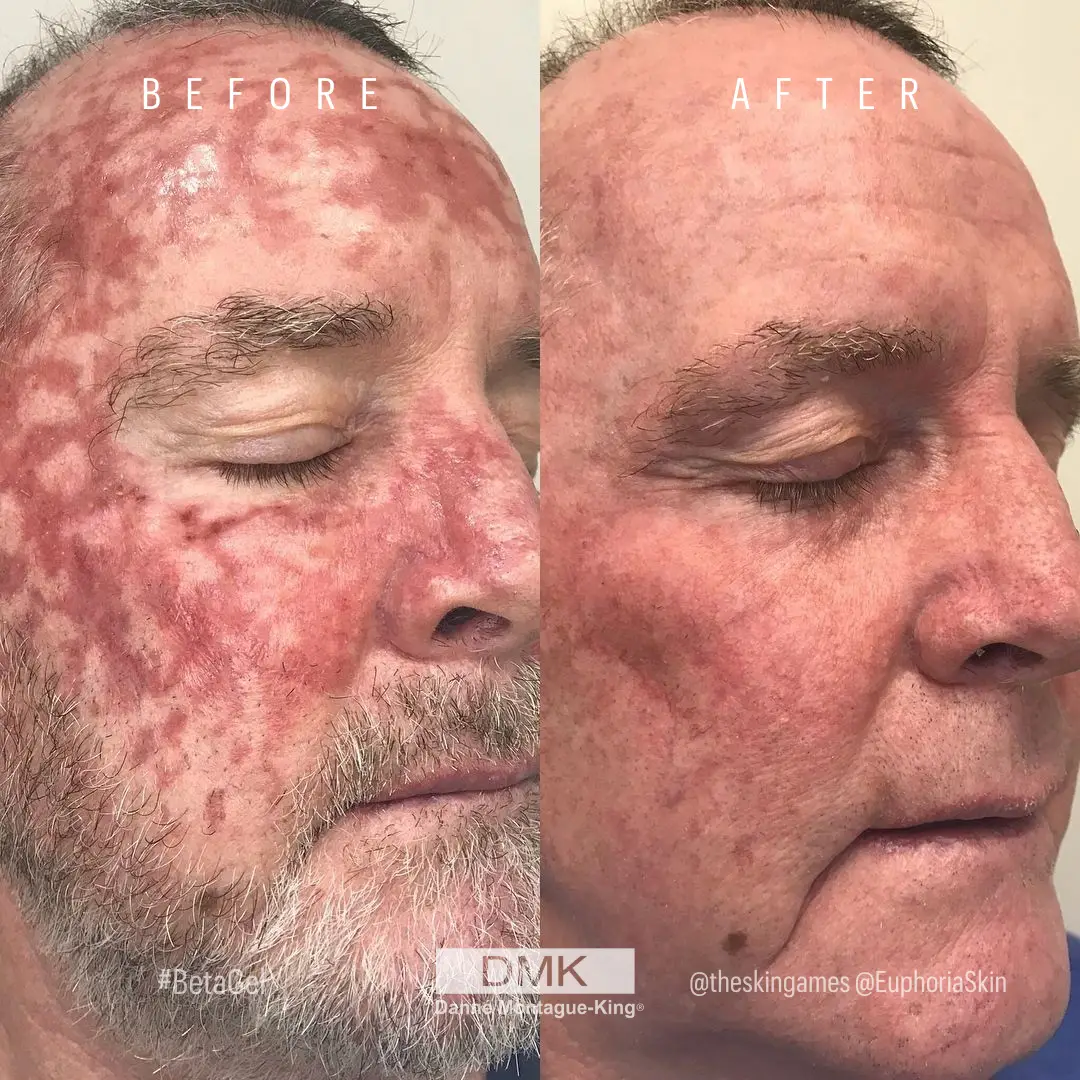 @theskingames-@EuphoriaSkin-Beta-Gel-with-LED-therap-5-week-Skin-Damage-Result-2 (1)