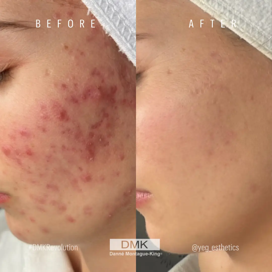 @yeg_esthetics-DMKDifference-Acne-2 (1)
