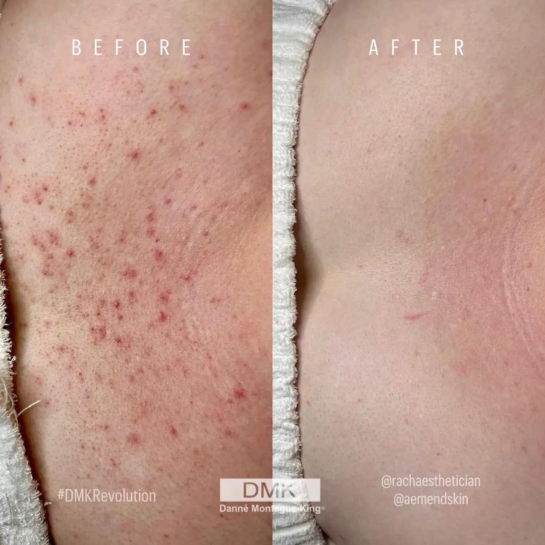EnbiomentTreatment