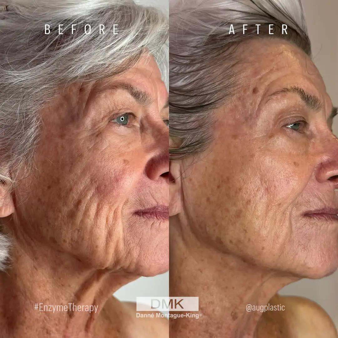 @augplastic 2x Enzyme Therapy Age Management B&A