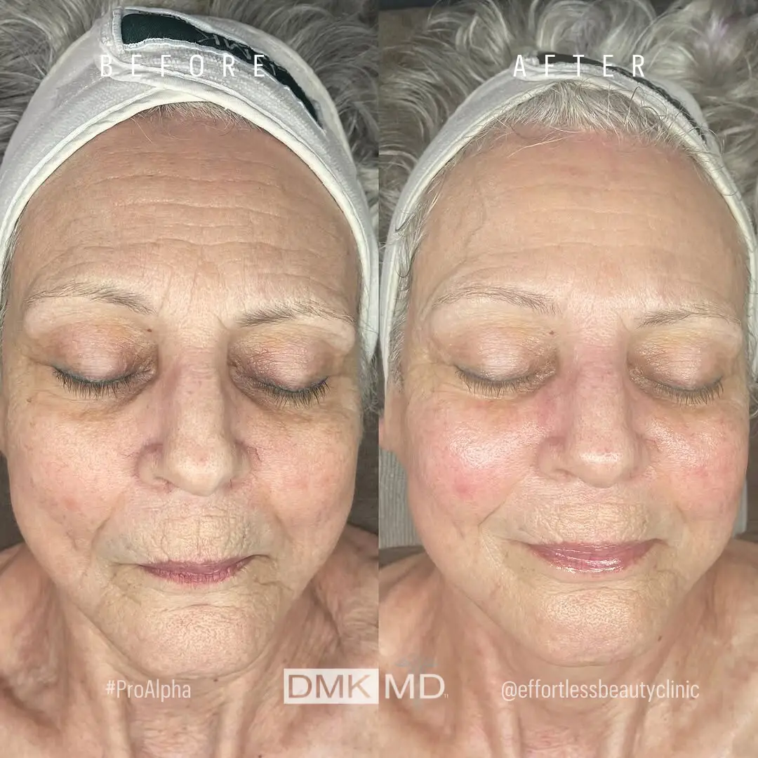 @effortlessbeautyclinic 1x ProAlpha Age Management B&A