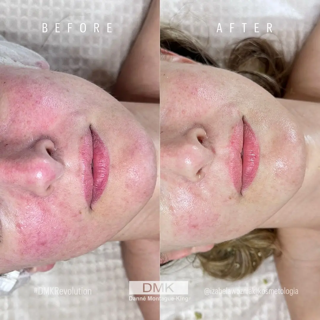 @izabelawozniak_kosmetologia Acne Rosacea 4 month #DMKDifference