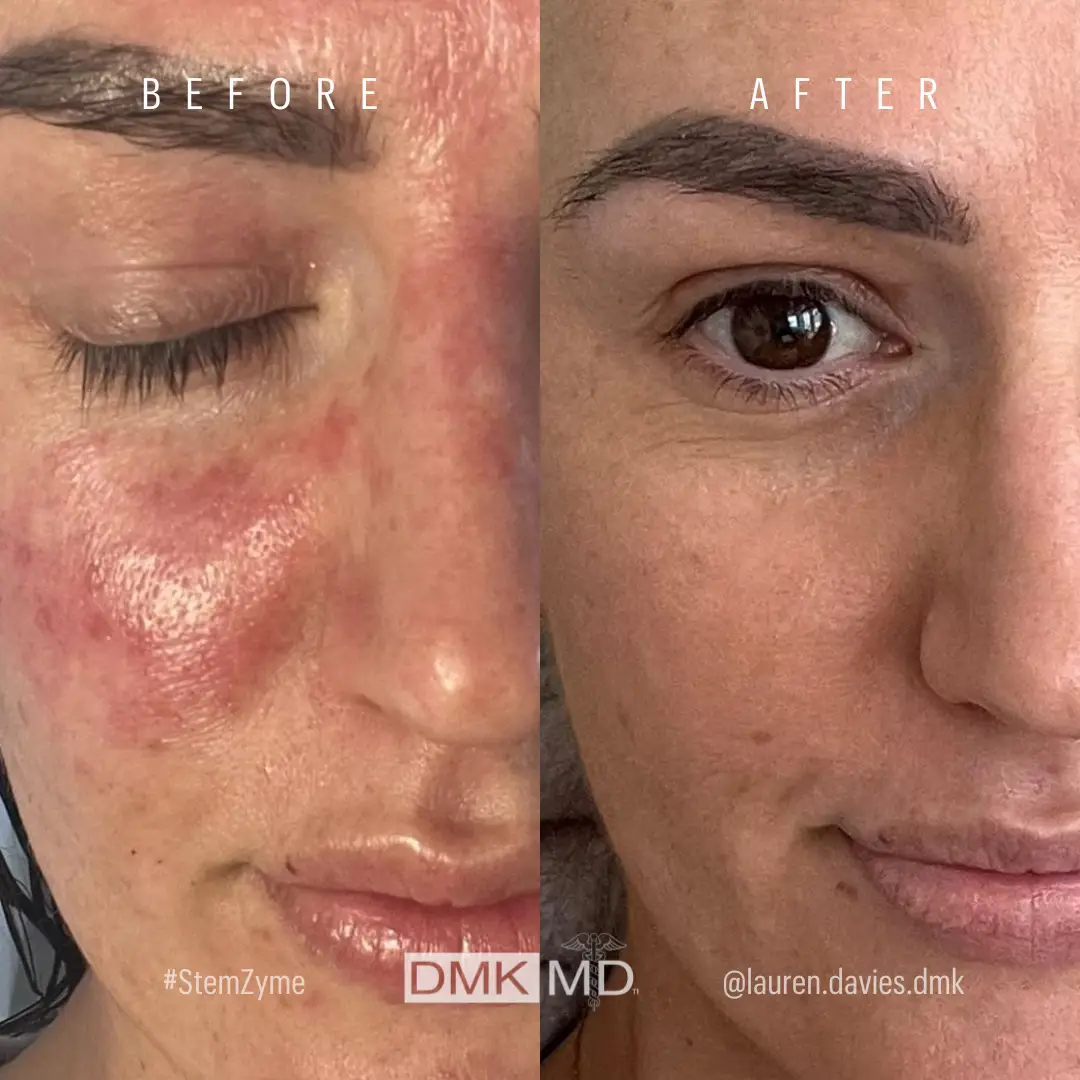 Rosacea