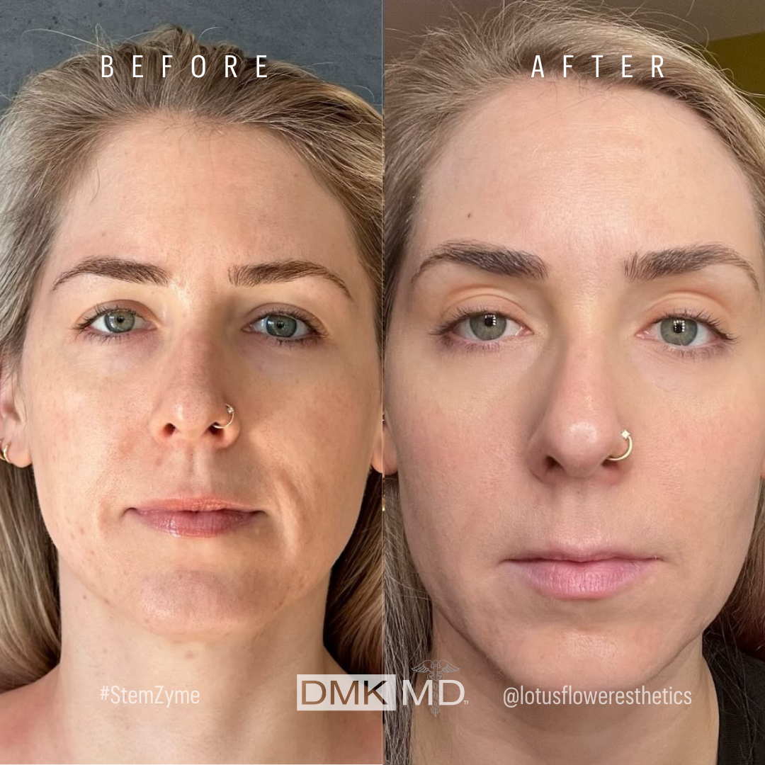 @lotusfloweresthetics StemZyme Result performed by 34 years old