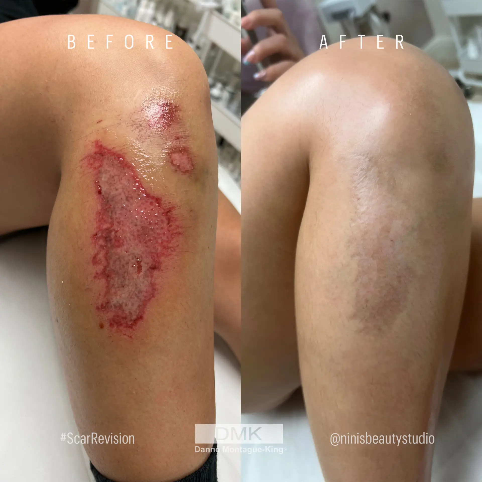 Scar Revision