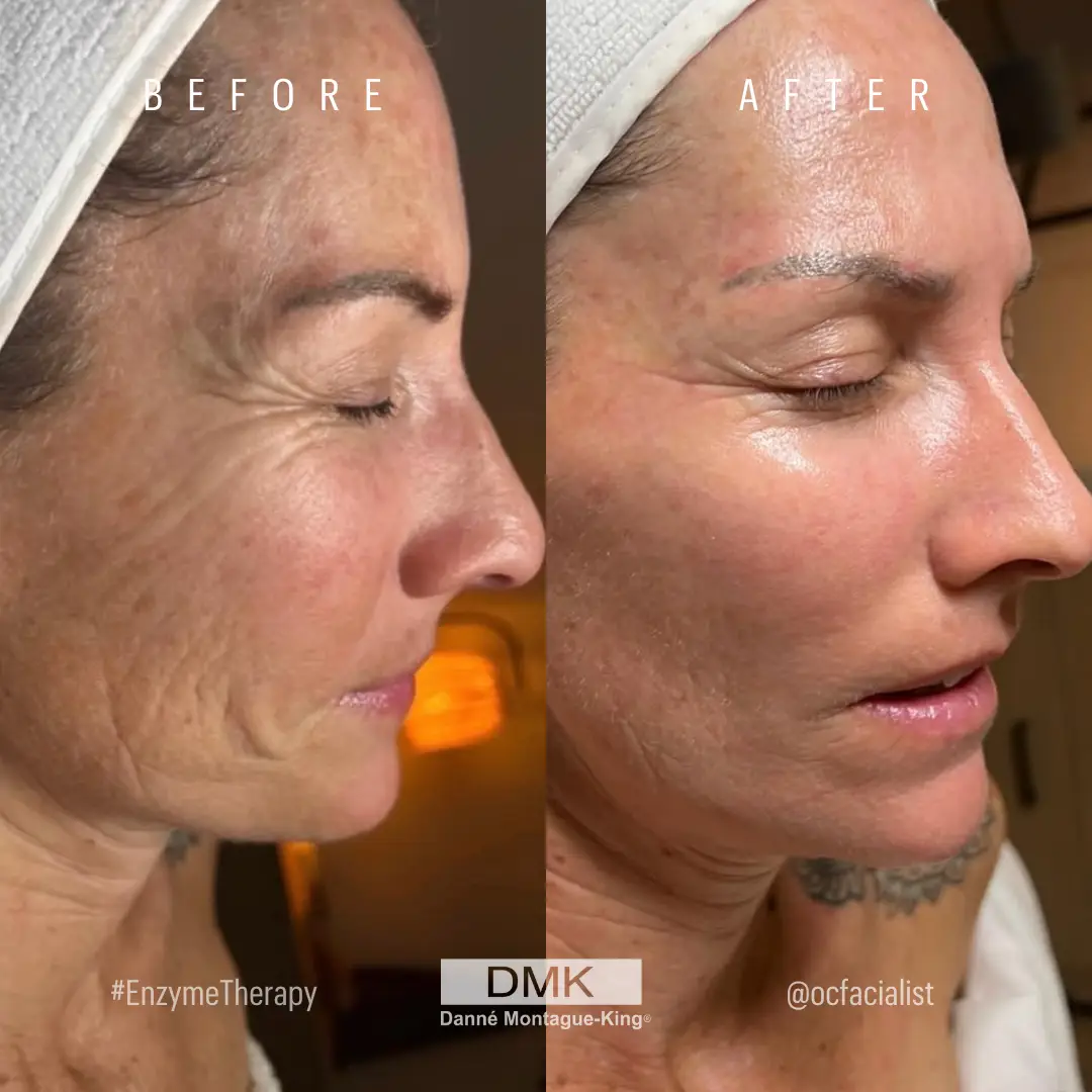 @ocfacialist 2x Enzyme Therapy B&A Age Management, Pigment, Glycation
