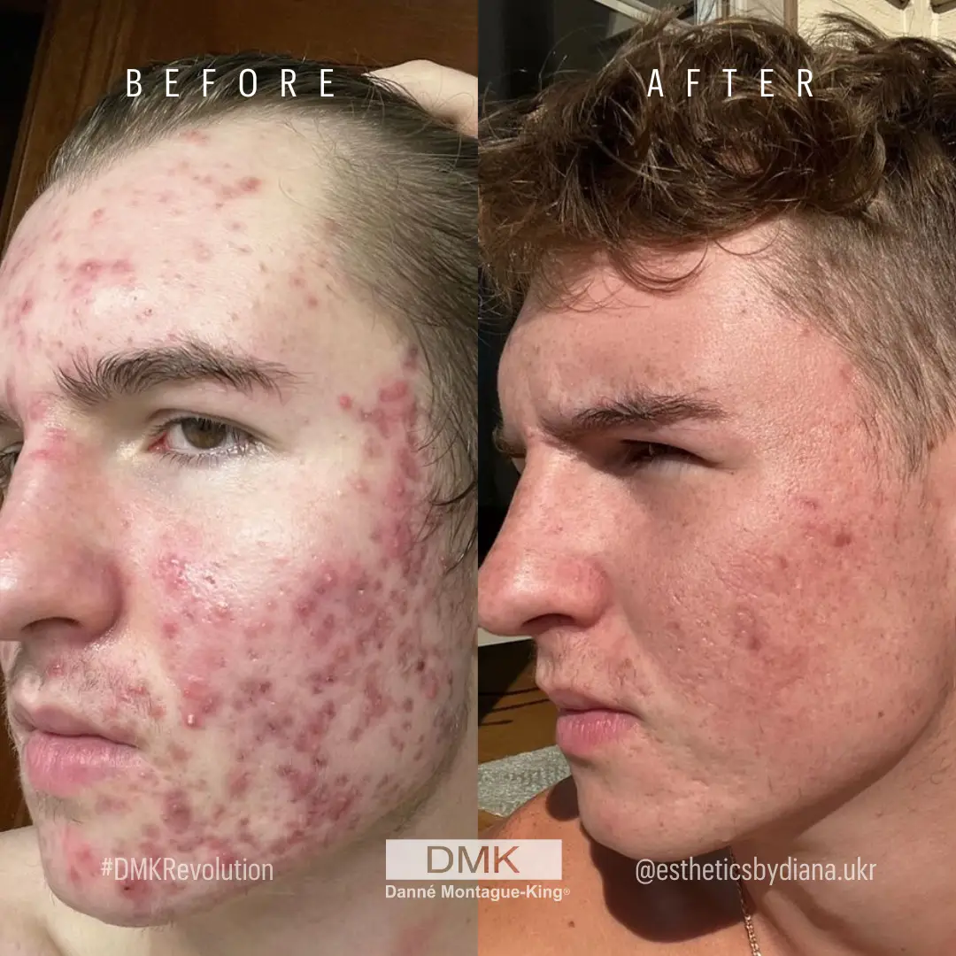 Hormonal Acne