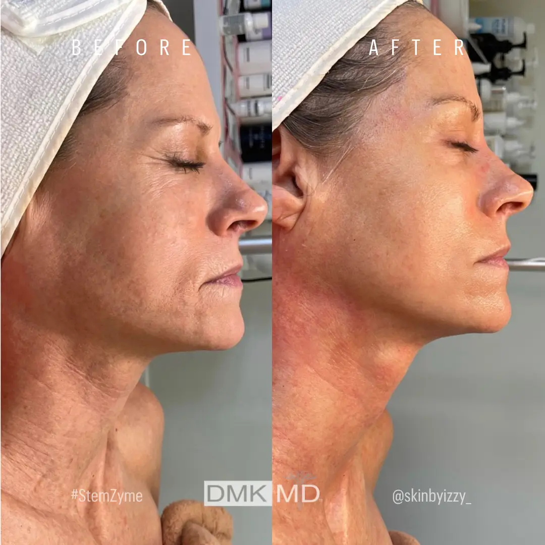 @skinbyizzy_ StemZyme (Day50) Age Management Glow Pigmentation B&A