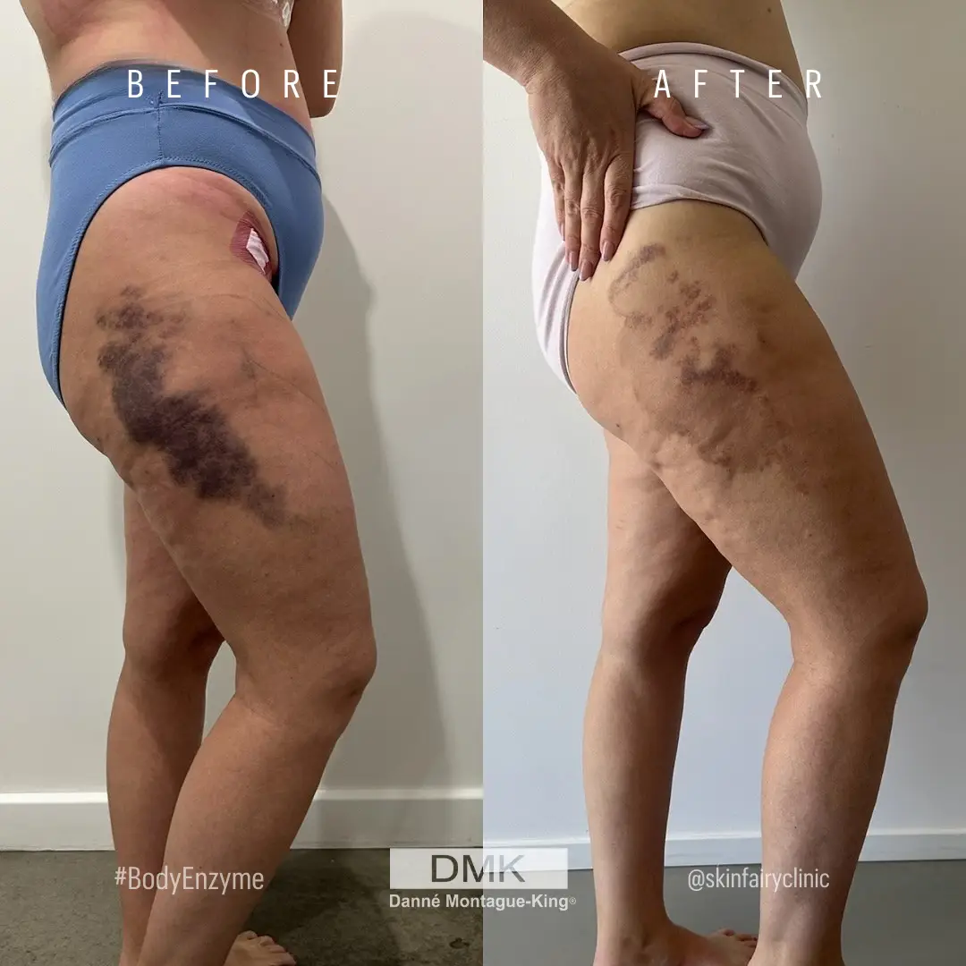 @skinfairyclinic @theskinfairy_ Body Enzyme Post Op Bruising B&A