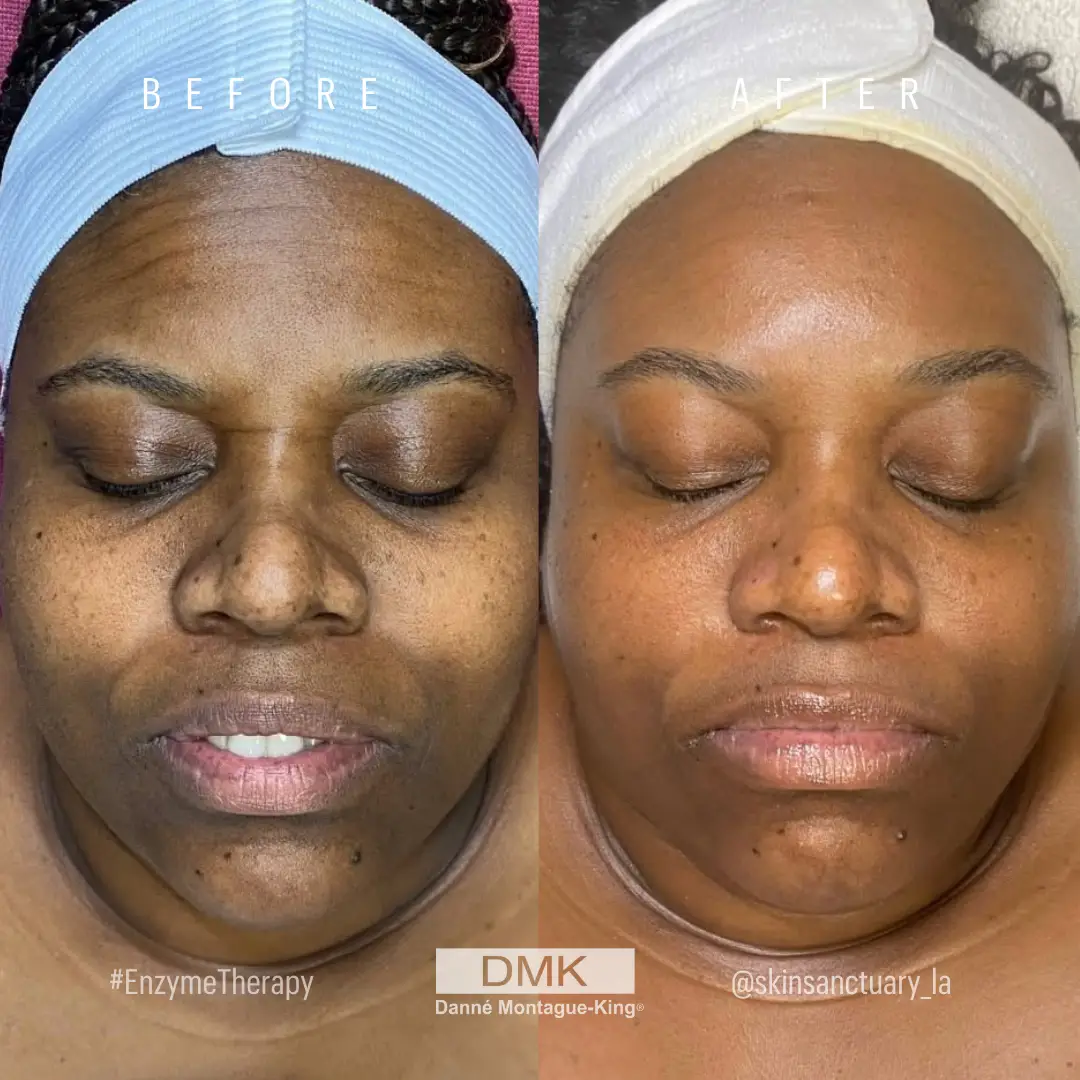 @skinsanctuary_la Enzyme Therapy Difference Melanated Skin Age MGMT Pigmentation B&A