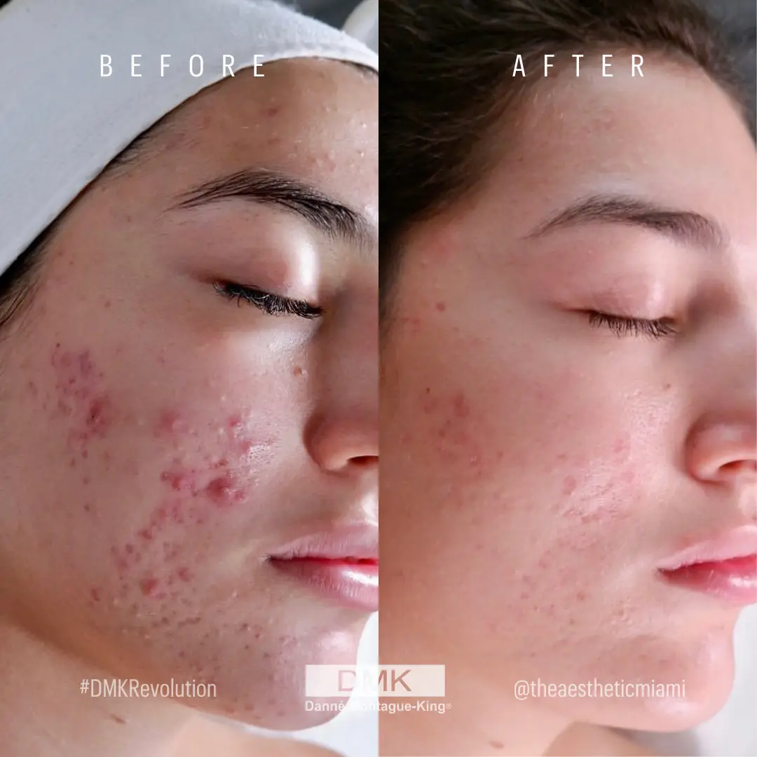 @theaestheticmiami 3 months, 4 appointments #DMKDifference Cystic Acne B&A