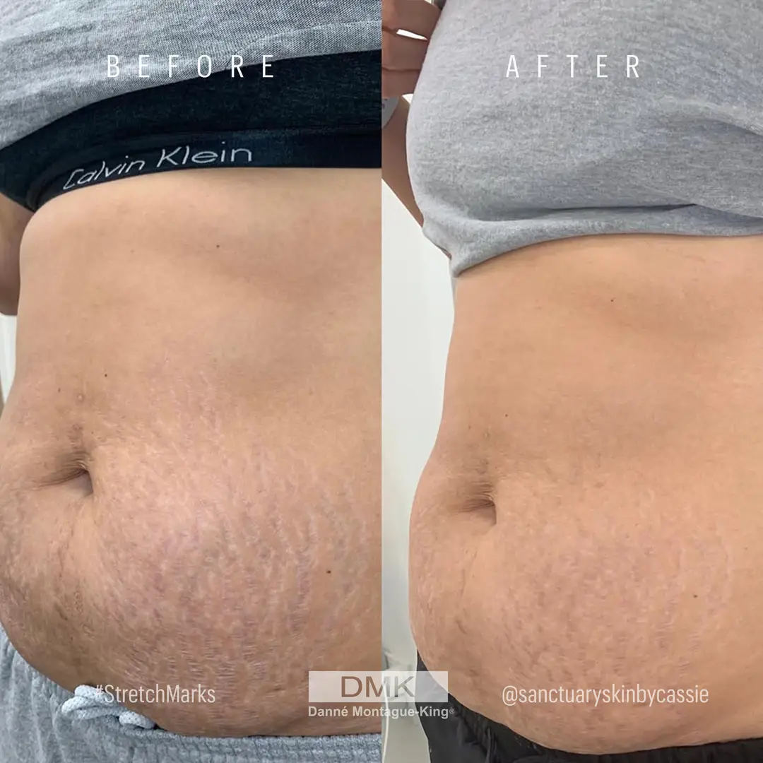 @sanctuaryskinbycassie-DMK-Body-Enzyme-Stretch-Marks-B&A