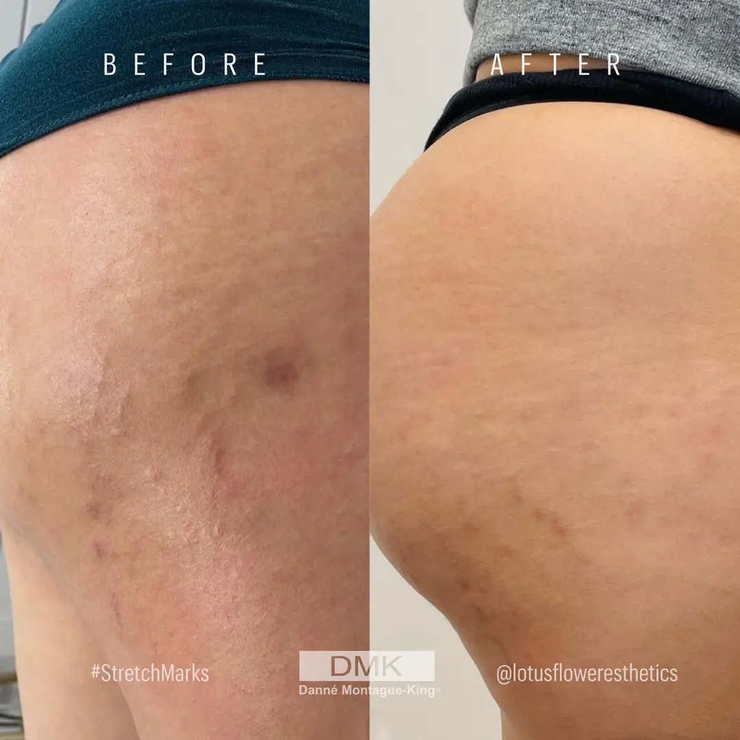 Body-Stretch-Mark-progress-@lotusfloweresthetics-carousel