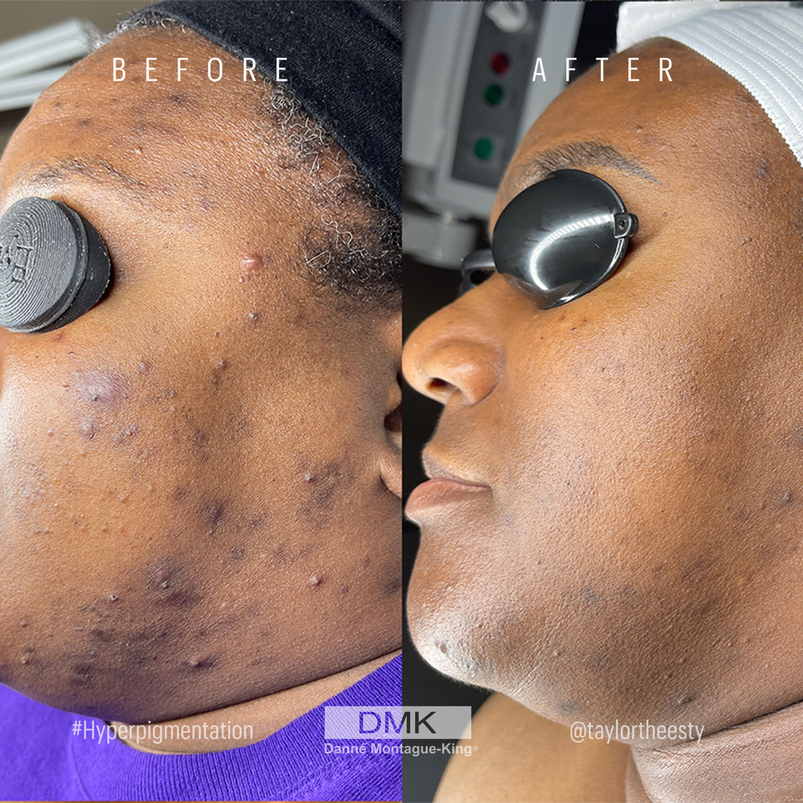@taylortheesty_hyperpigmentation